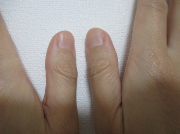 指の変形性関節症によるレントゲン撮影